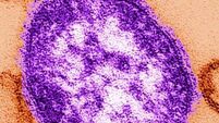 Three more possible measles cases reported in Ireland