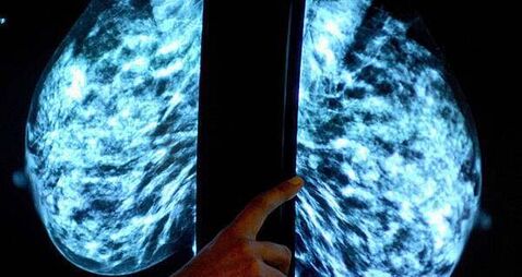 HSE breast cancer screening programme misses targets for past two years