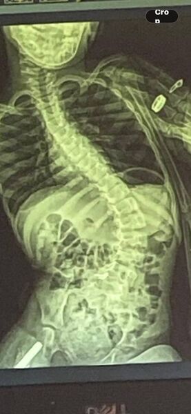 An x-ray showing the extreme curvature of Roxanne's spine due to scoliosis