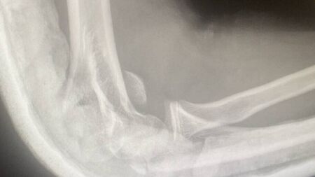 Teen suffers broken arm in filmed beating