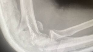 <p>The X-Ray of the teen's fractured arm</p>