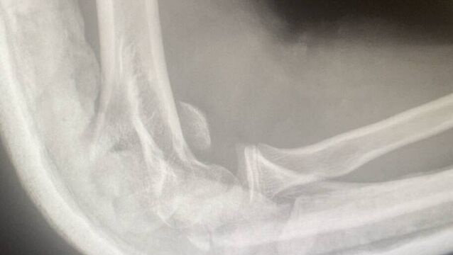Teen suffers broken arm in filmed beating