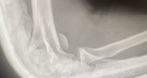 Teen suffers broken arm in filmed beating
