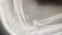 Teen suffers broken arm in filmed beating