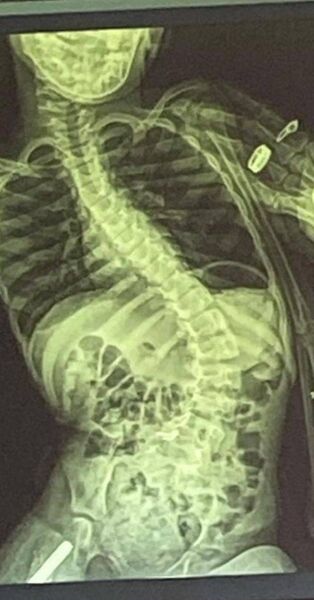 An x-ray of Roxanne's spine before the operation, showing the extreme curvature due to her scoliosis An x-ray of Roxanne's spine before the operation, showing the extreme curvature due to her scoliosis