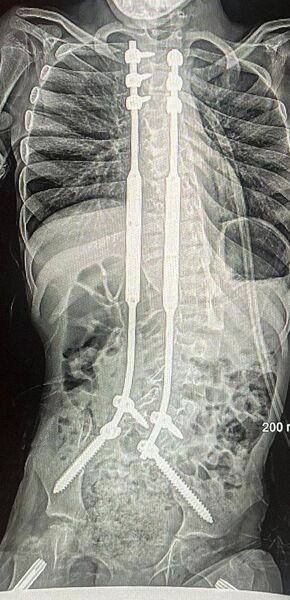 Roxanne's spine after the surgery in the USA, with the two magnetic rods to help straighten it Roxanne's spine after the surgery in the USA, with the two magnetic rods to help straighten it